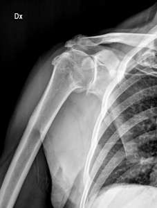 Un’immagine radiografica che mostra un’artrosi eccentrica della spalla