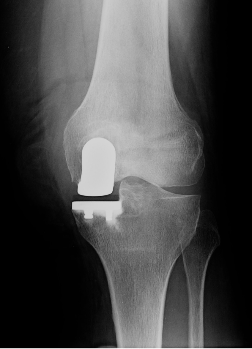 protesi di ginocchio parziale