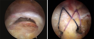 I tendini della cuffia dei rotatori prima (a sinistra) e dopo (a destra) la sutura in artroscopia.