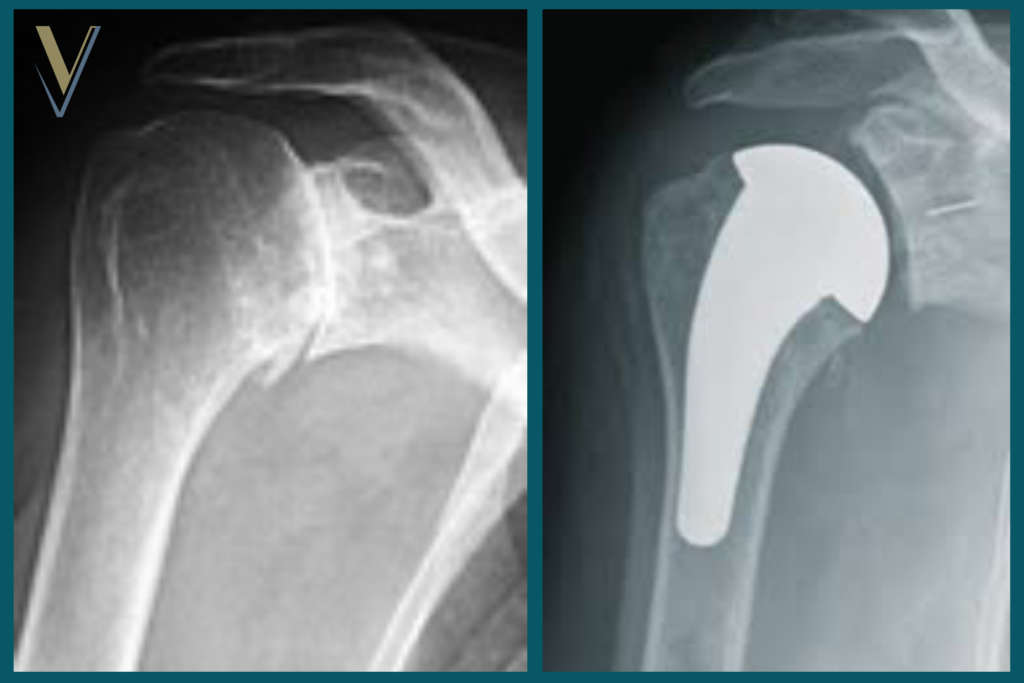 Artrosi di spalla e protesi anatomica - Dr. Ortopedico Visona