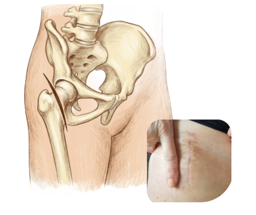 Artrosi dell’anca: la soluzione mini-invasiva