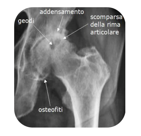 Artrosi dell’anca: la soluzione mini-invasiva