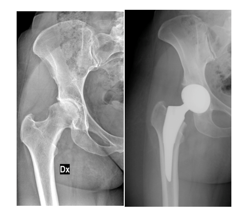 Artrosi dell’anca: la soluzione mini-invasiva