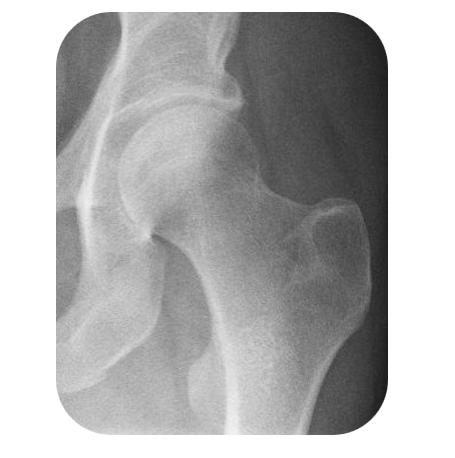 Artrosi dell’anca: la soluzione mini-invasiva